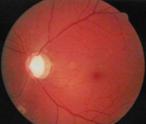 視神経乳頭の深い陥凹の末期の眼底写真