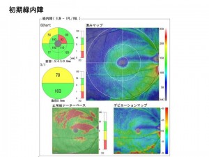 初期緑内障