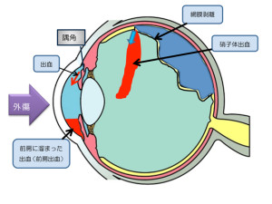 外傷による様々な眼の障害