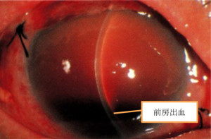 前房出血