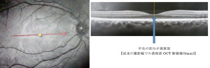 黄斑ライン（左）／旧OCT断面図（右）