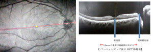 新黄斑ライン（写真左）／新OCT断面図（写真右）